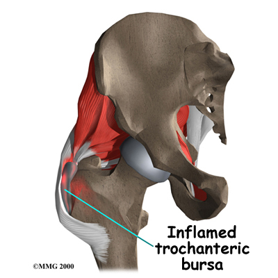 Bursitis of the Hip  Regenexx® Pittsburgh