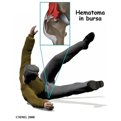 Bursitis of the Hip  Regenexx® Pittsburgh