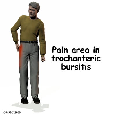 https://www.greaterpittsburghphysicaltherapy.com/media/img/1087/hip_trochburs_symptom01.jpg