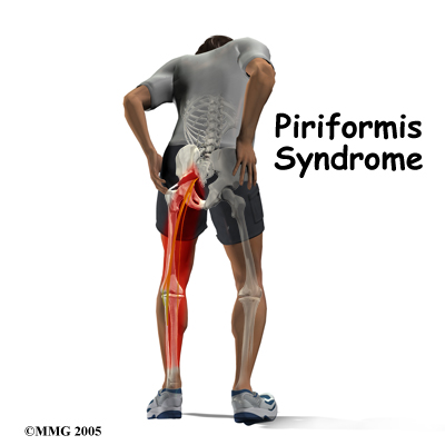 Piriformis Syndrom - Explained: Pittsburgh Physical Medicine and