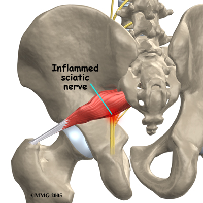 Piriformis Syndrom - Explained: Pittsburgh Physical Medicine and