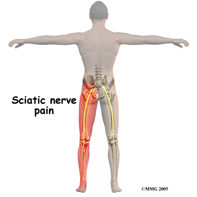 Piriformis Syndrom - Explained: Pittsburgh Physical Medicine and