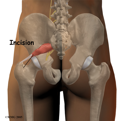 https://www.greaterpittsburghphysicaltherapy.com/media/img/733/piriformis_surgery01.jpg