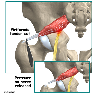 Piriformis Syndrom - Explained: Pittsburgh Physical Medicine and